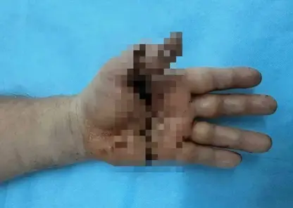 Новосибирские микрохирурги пришили мужчине отрезанную руку