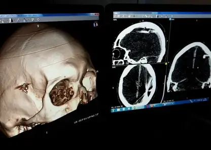 Барнаулец сутки проходил с пулей в голове