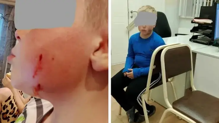 Бродячая собака укусила за лицо 8-летнего ребенка в Омске