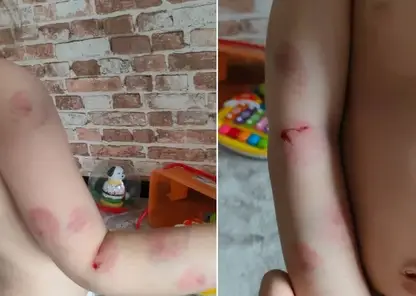 Суд в Омске взыскал 100 тысяч рублей компенсации за укусы ребенка в детском саду