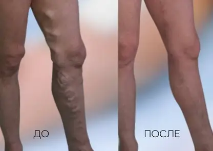 Современное лечение варикоза: как лазерная коагуляция возвращает здоровье ногам