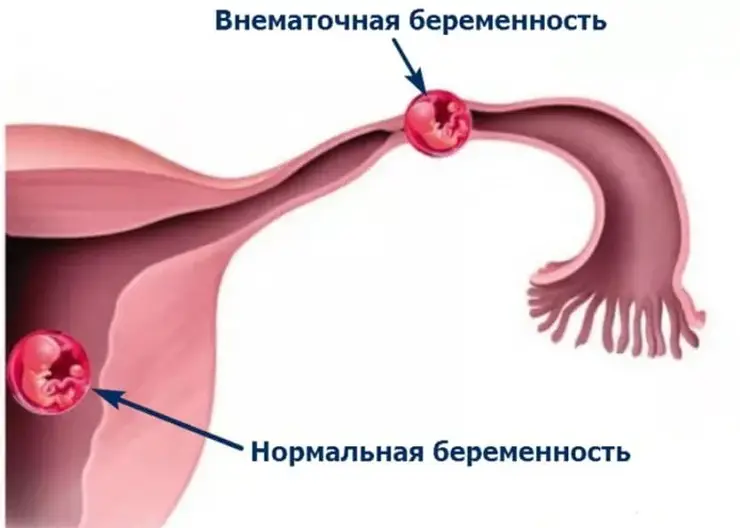 Красноярские врачи спасли женщину с двумя беременностями