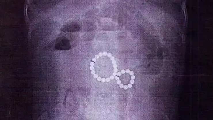 В Иркутске врачи спасли двухлетнюю девочку, проглотившую 29 магнитов