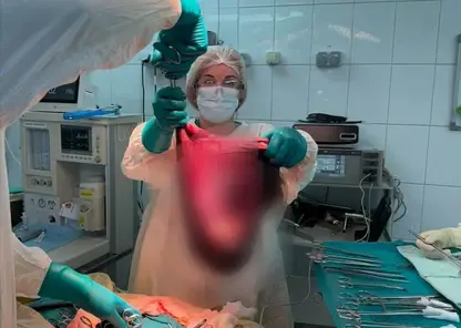 В Красноярске женщине удалили опухоль яичника гигантского размера