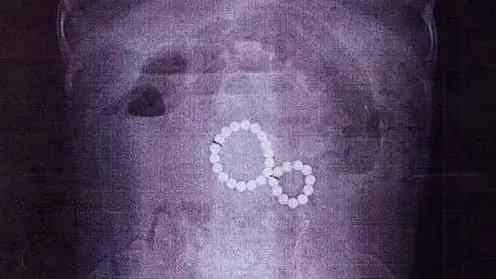 В Иркутске врачи спасли двухлетнюю девочку, проглотившую 29 магнитов