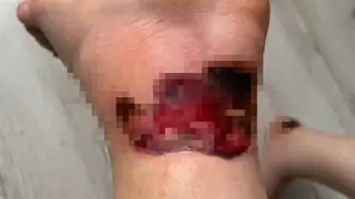 Пациентка тюменской больницы получила тяжёлый ожог и едва не лишилась ноги