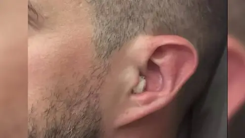 Житель Томска подцепил опасную бактерию и оглох после купания в речке