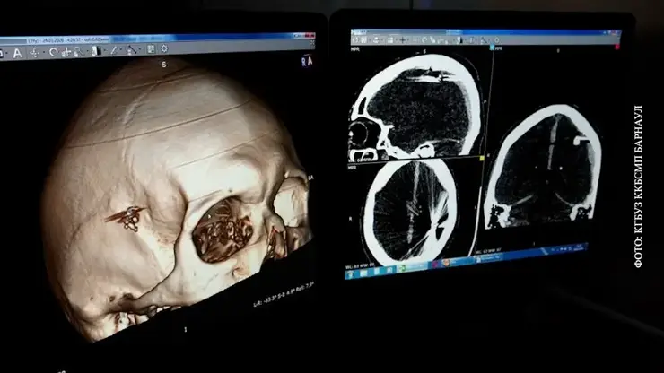 Барнаулец сутки проходил с пулей в голове