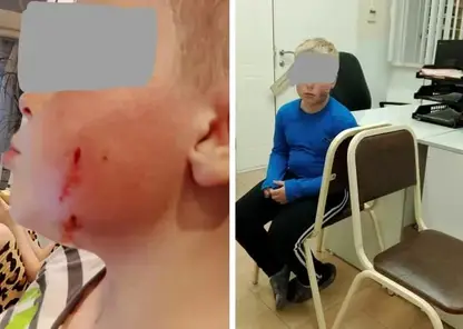 Бродячая собака укусила за лицо 8-летнего ребенка в Омске