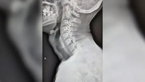 Врачи спасли красноярца, проглотившего рыболовный крючок