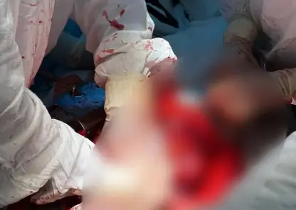 Красноярцу удалили опухоль размером с футбольный мяч