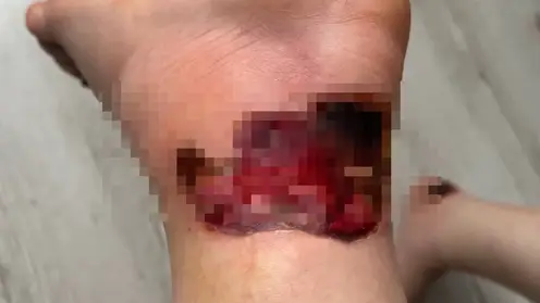 Пациентка тюменской больницы получила тяжёлый ожог и едва не лишилась ноги