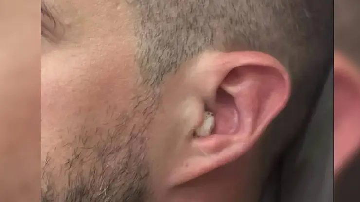 Житель Томска подцепил опасную бактерию и оглох после купания в речке