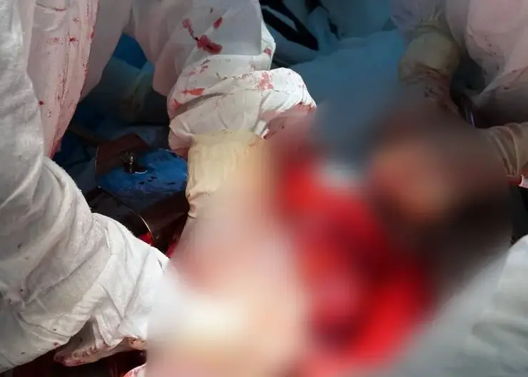 Красноярцу удалили опухоль размером с футбольный мяч