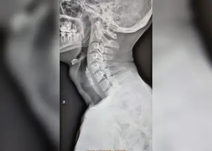 Врачи спасли красноярца, проглотившего рыболовный крючок