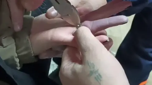 Новосибирские спасатели помогли девушке снять кольцо с отёкшего пальца