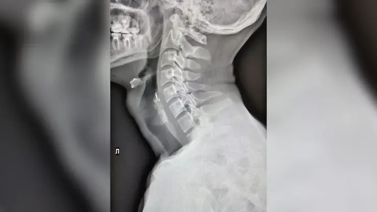 Врачи спасли красноярца, проглотившего рыболовный крючок