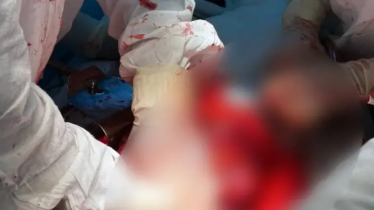 Красноярцу удалили опухоль размером с футбольный мяч