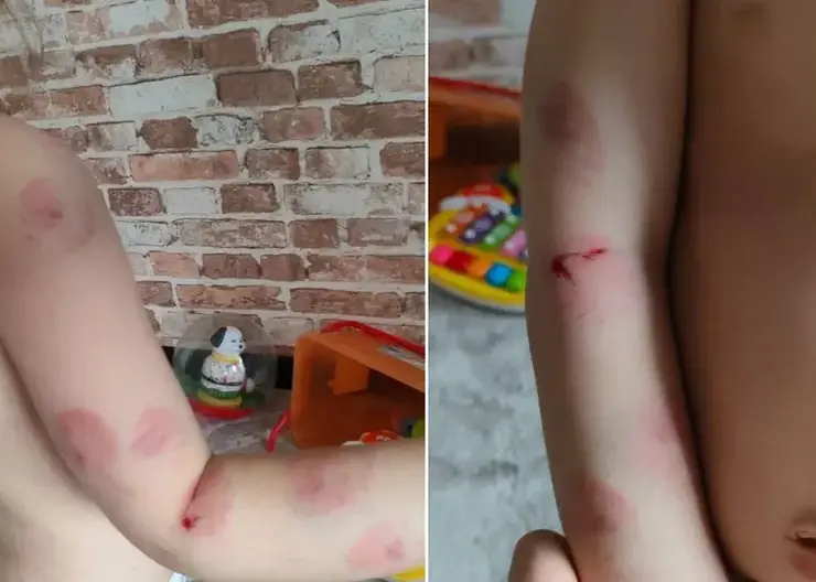 Суд в Омске взыскал 100 тысяч рублей компенсации за укусы ребенка в детском саду