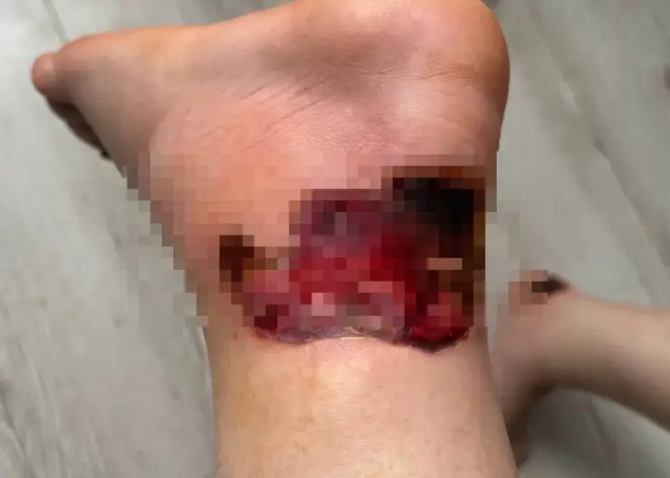 Пациентка тюменской больницы получила тяжёлый ожог и едва не лишилась ноги