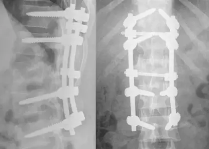Красноярец сломал позвоночник из-за катания на плюшке