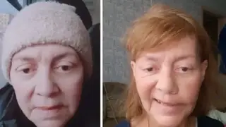 Трагедия после пластики: лицо красноярки изменилось до неузнаваемости Трагедия после пластики: лицо красноярки изменилось до неузнаваемости