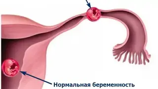 Красноярские врачи спасли женщину с двумя беременностями Красноярские врачи спасли женщину с двумя беременностями